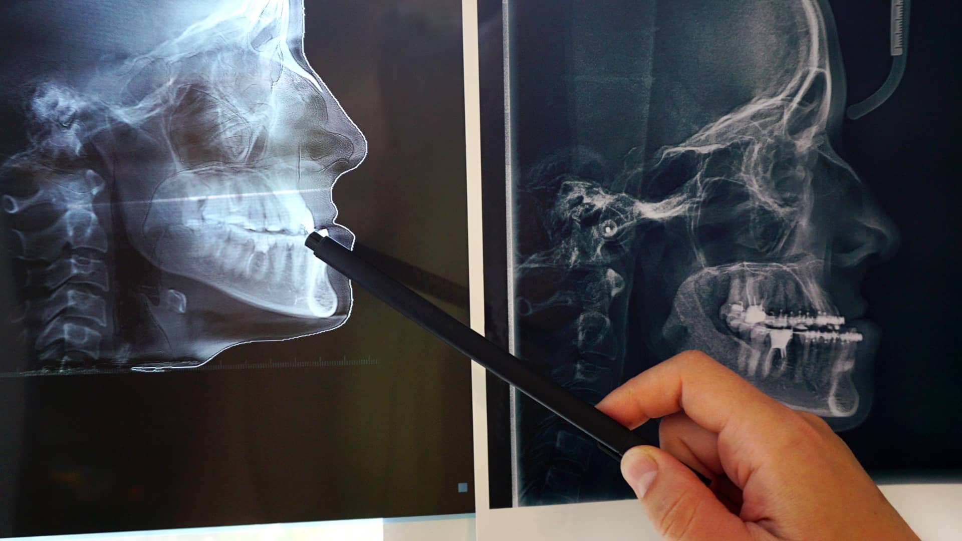 Médico maxilofacial del cuadro médico del seguro adeslas revisando la tomografía de un paciente