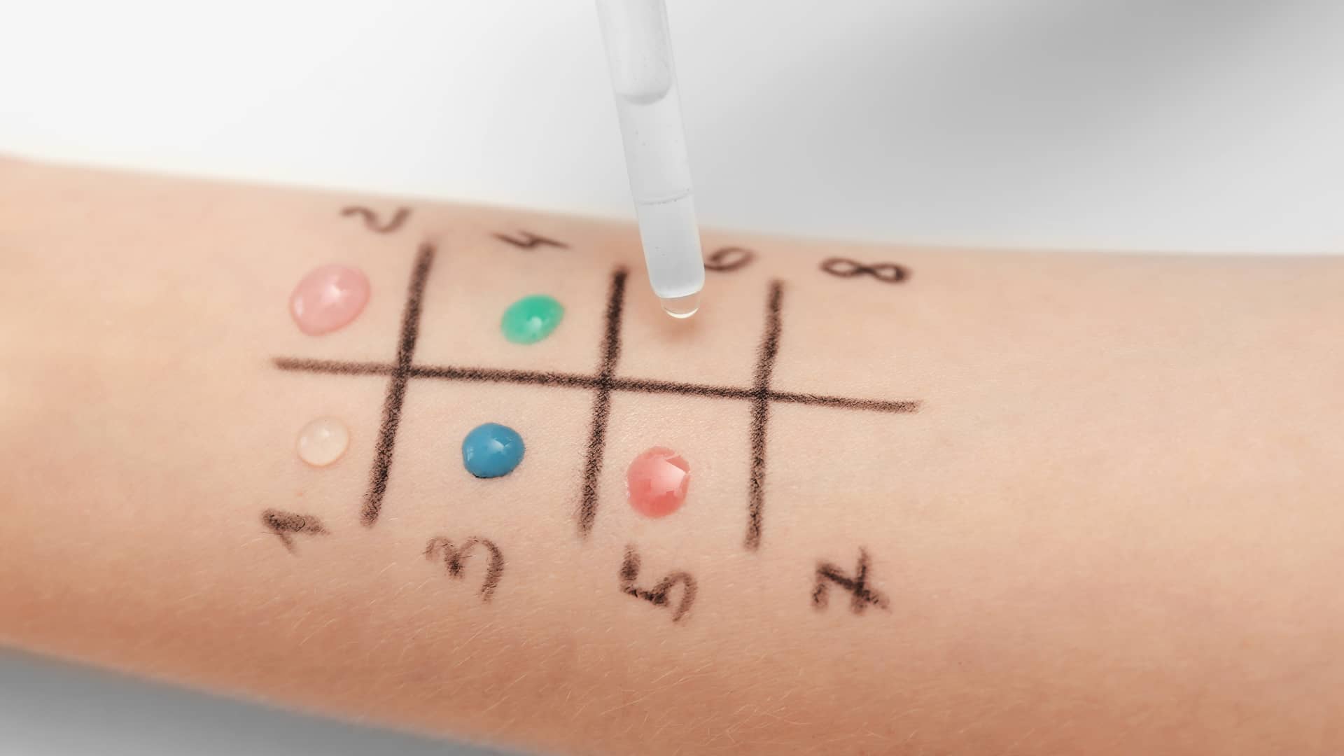 brazo de un paciente de asisa sometiendose a unas pruebas con su medico alergologo