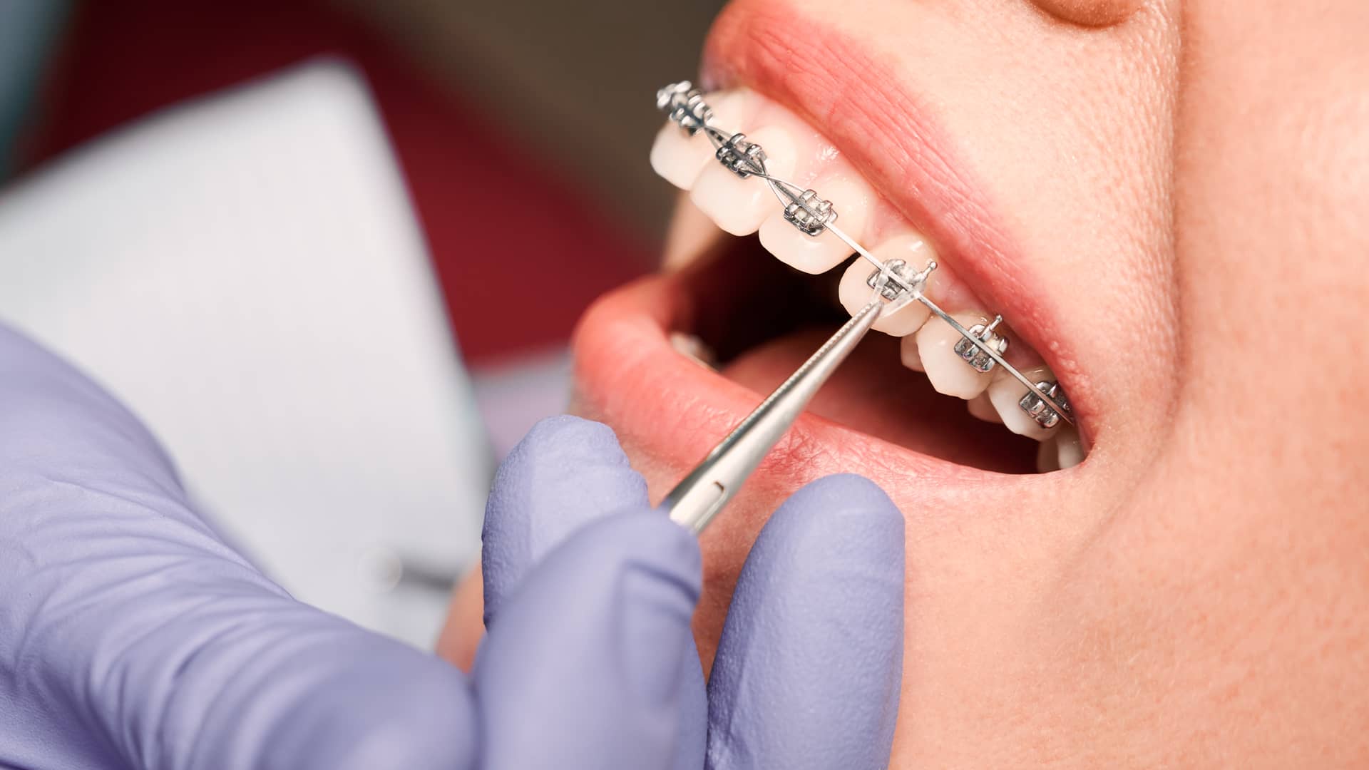 Mujer acudiendo a revisión de su aparato dental a su dentista de confianza a traves de su seguro dental con el racc